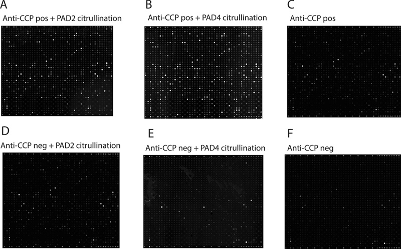 Imaging of autoantibody binding to protein arrays.